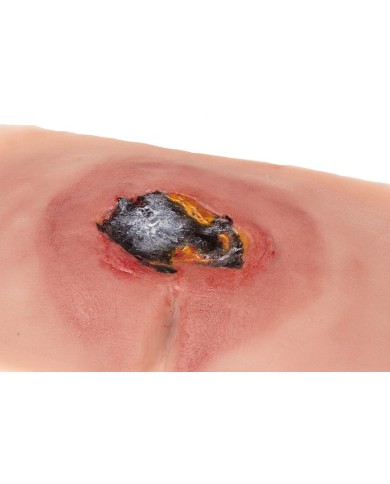 Moulage di ulcera da decubito sacrale non trattata PW001A