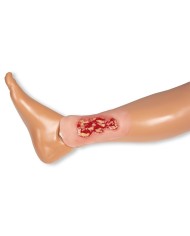 Moulage di ulcera venosa della gamba piccola fase di essudazione PW002A