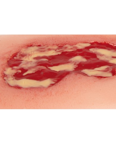 Moulage di ulcera venosa della gamba piccola fase di essudazione PW002A