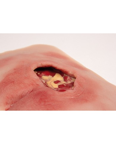 Moulage di ulcera da decubito sacrale pulita PW001B