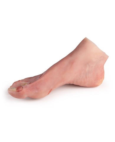 Piede ferito con sindrome da diabete stadio grave PW007