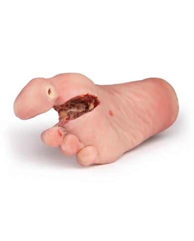 Piede ferito con sindrome da diabete stadio grave PW007