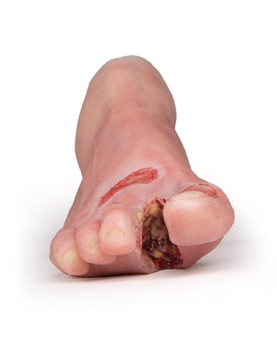 Piede ferito con sindrome da diabete stadio grave PW007