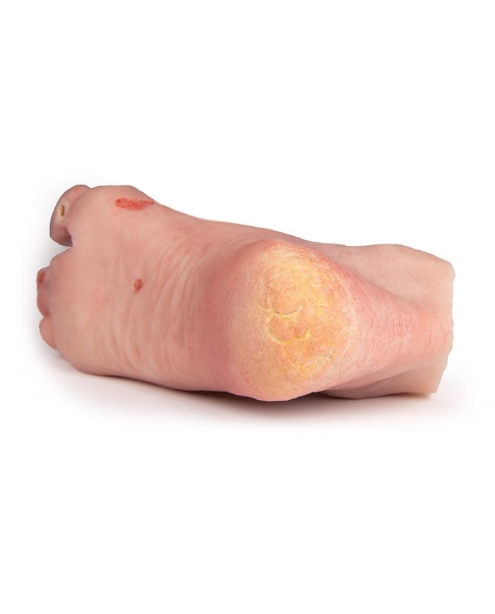 Piede ferito con sindrome da diabete stadio grave PW007