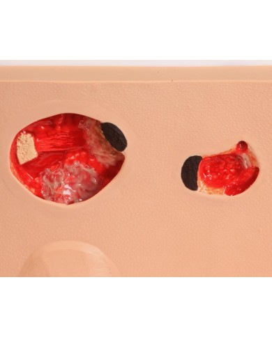 Stadi diversi di ulcera da pressione Erler Zimmer R10167