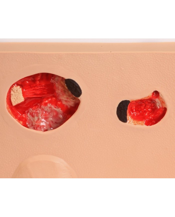 Stadi diversi di ulcera da pressione Erler Zimmer R10167