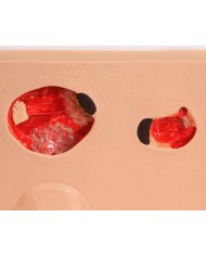 Stadi diversi di ulcera da pressione Erler Zimmer R10167