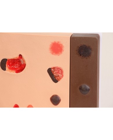 Stadi diversi di ulcera da pressione Erler Zimmer R10167