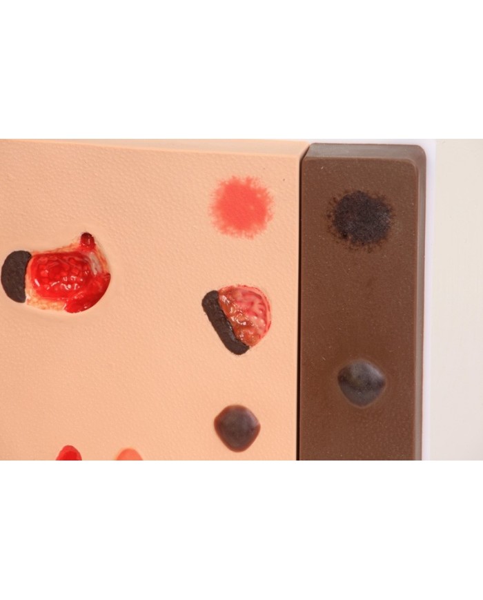 Stadi diversi di ulcera da pressione Erler Zimmer R10167