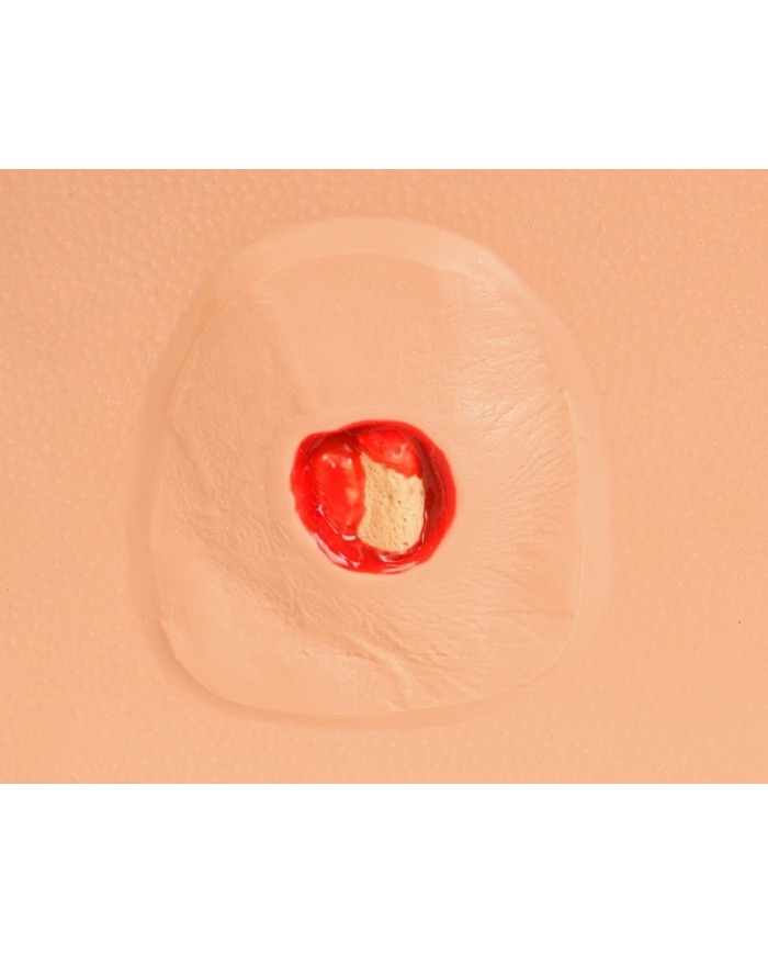 Stadi diversi di ulcera da pressione Erler Zimmer R10167