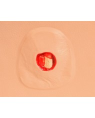 Stadi diversi di ulcera da pressione Erler Zimmer R10167