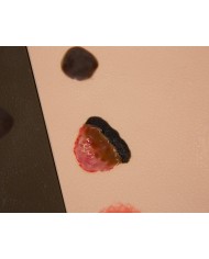 Stadi diversi di ulcera da pressione Erler Zimmer R10167