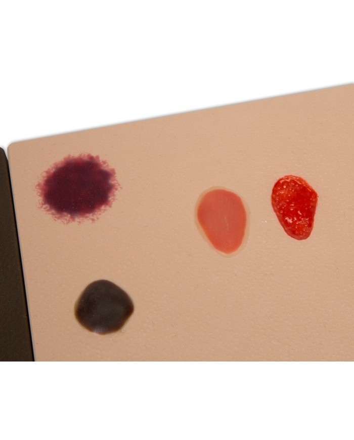 Stadi diversi di ulcera da pressione Erler Zimmer R10167