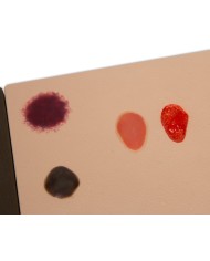 Stadi diversi di ulcera da pressione Erler Zimmer R10167