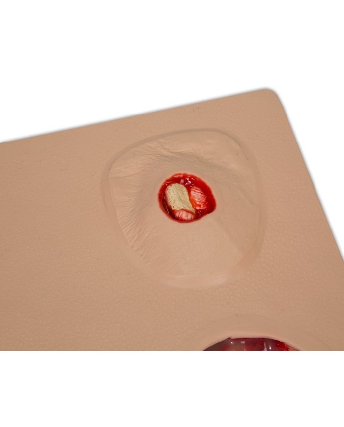 Stadi diversi di ulcera da pressione Erler Zimmer R10167