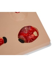 Stadi diversi di ulcera da pressione Erler Zimmer R10167