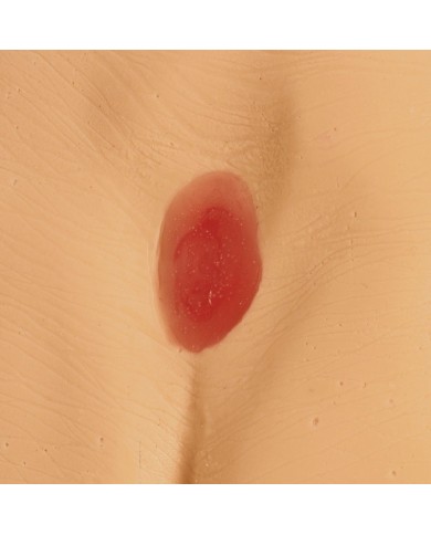 Modelli di ulcere da decubito e piaghe da decubito Erler Zimmer R11047