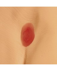 Modelli di ulcere da decubito e piaghe da decubito Erler Zimmer R11047