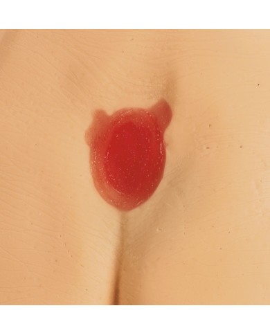 Modelli di ulcere da decubito e piaghe da decubito Erler Zimmer R11047