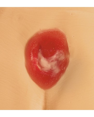 Modelli di ulcere da decubito e piaghe da decubito Erler Zimmer R11047