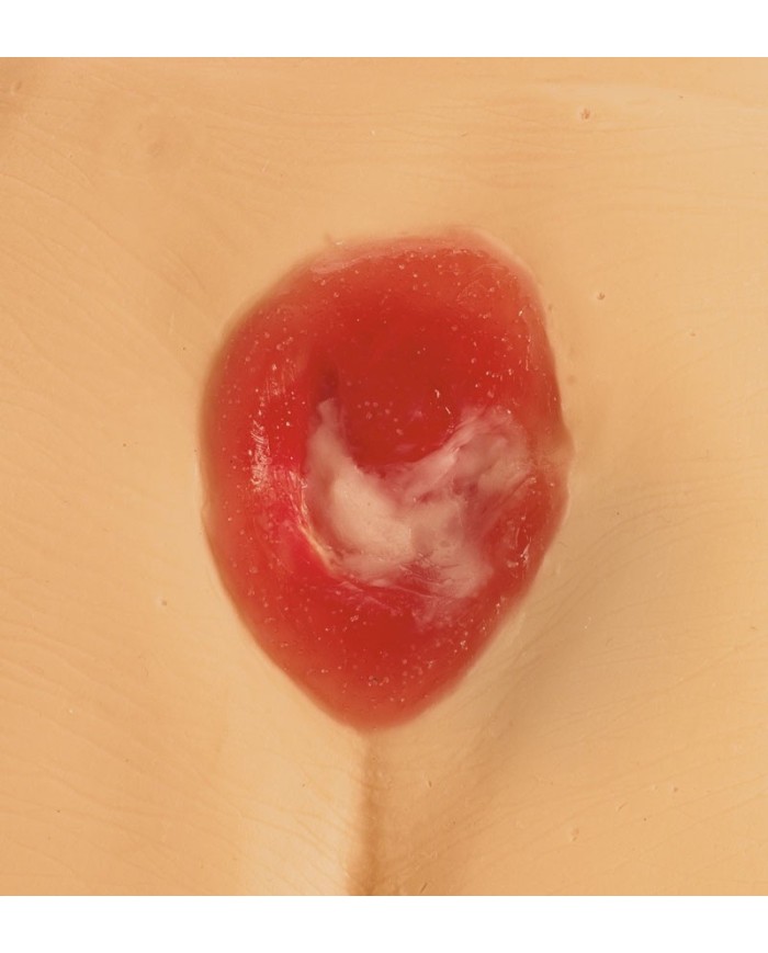 Modelli di ulcere da decubito e piaghe da decubito Erler Zimmer R11047