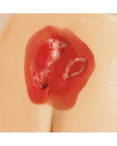 Modelli di ulcere da decubito e piaghe da decubito Erler Zimmer R11047