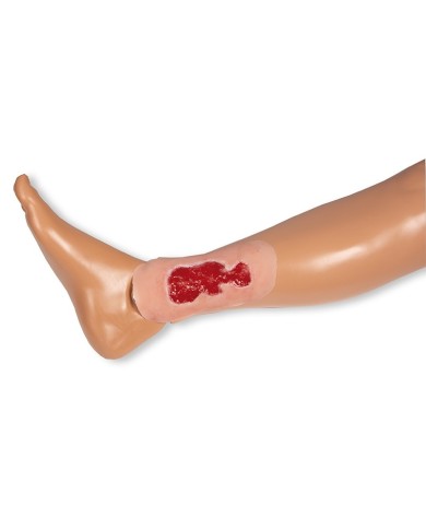 Moulage di ferita da ulcera venosa della gamba piccola in fase di granula