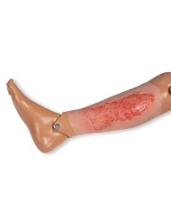 Moulage di ferita da ulcera venosa degli arti inferiori ampia in fase di 