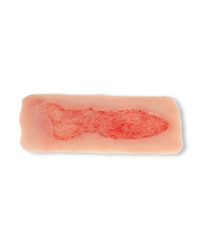 Moulage di ferita da ulcera venosa degli arti inferiori ampia in fase di 