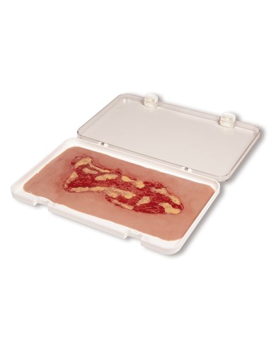 Moulage di ferita da ulcera venosa degli arti inferiori ampia in fase di 