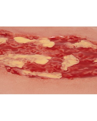 Moulage di ferita da ulcera venosa degli arti inferiori ampia in fase di 