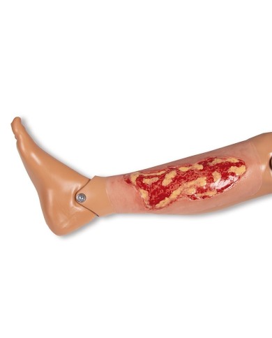 Moulage di ferita da ulcera venosa degli arti inferiori ampia in fase di 