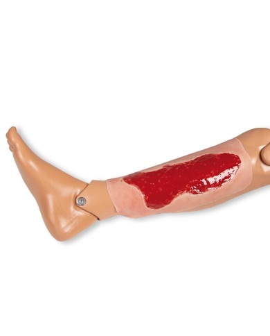 Moulage di ferita da ulcera venosa degli arti inferiori ampia in fase di 