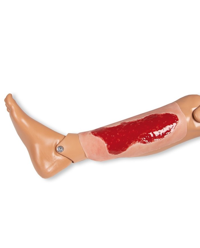 Moulage di ferita da ulcera venosa degli arti inferiori ampia in fase di 