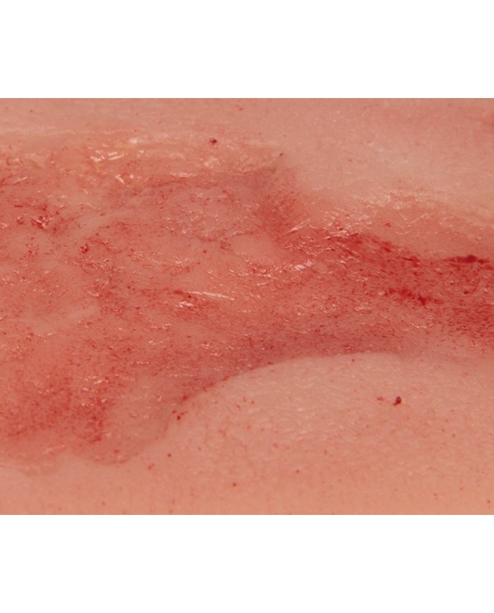 Moulage di ferita da ulcera venosa degli arti inferiori piccola in fase d Moulage di ferita da ulcera venosa degli arti inferiori piccola in fase d