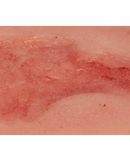 Moulage di ferita da ulcera venosa degli arti inferiori piccola in fase d Moulage di ferita da ulcera venosa degli arti inferiori piccola in fase d