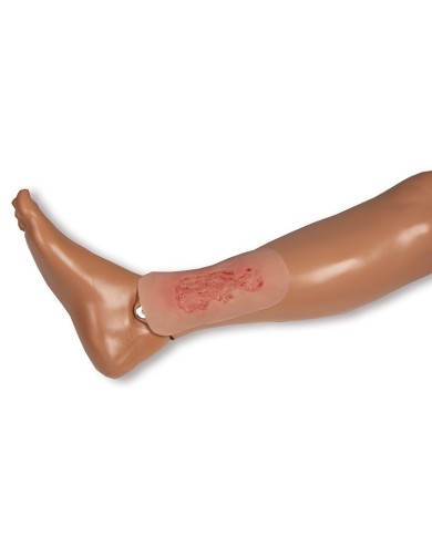 Moulage di ferita da ulcera venosa degli arti inferiori piccola in fase d