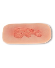 Moulage di ferita da ulcera venosa degli arti inferiori piccola in fase d Moulage di ferita da ulcera venosa degli arti inferiori piccola in fase d
