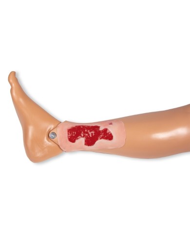 Moulage di ferita da ulcera arteriosa degli arti inferiori piccola in fas