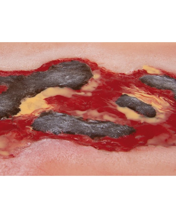 Moulage di ferita da ulcera arteriosa degli arti inferiori grande in fase