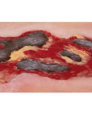 Moulage di ferita da ulcera arteriosa degli arti inferiori grande in fase