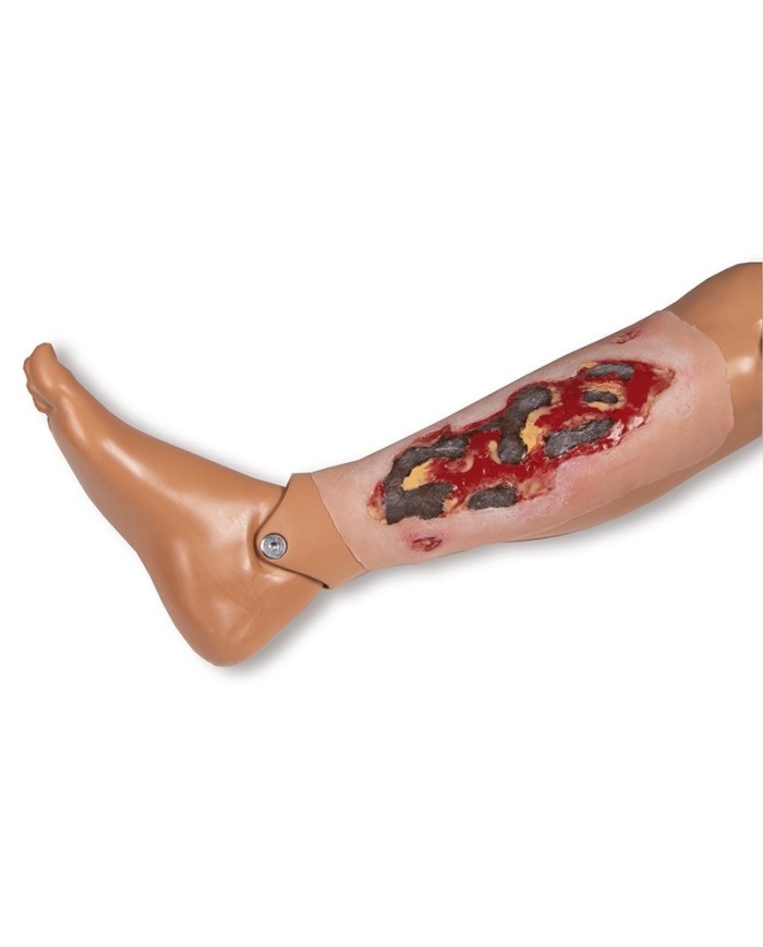 Moulage di ferita da ulcera arteriosa degli arti inferiori grande in fase
