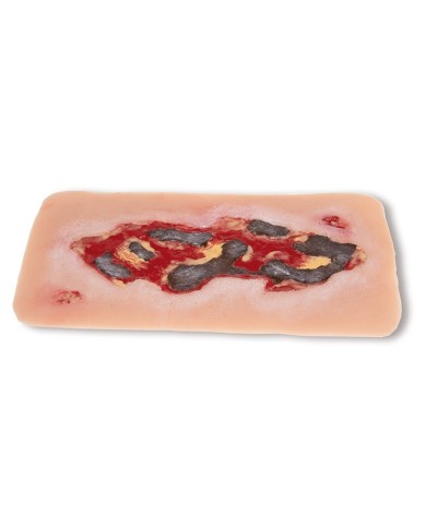 Moulage di ferita da ulcera arteriosa degli arti inferiori grande in fase