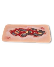 Moulage di ferita da ulcera arteriosa degli arti inferiori grande in fase