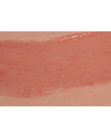 Moulage di ferita da ulcera arteriosa degli arti inferiori grande in fase