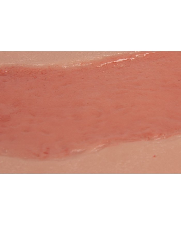 Moulage di ferita da ulcera arteriosa degli arti inferiori grande in fase