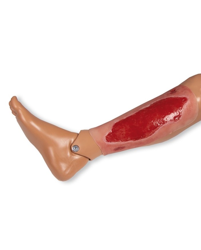 Moulage di ferita da ulcera arteriosa degli arti inferiori grande in fase