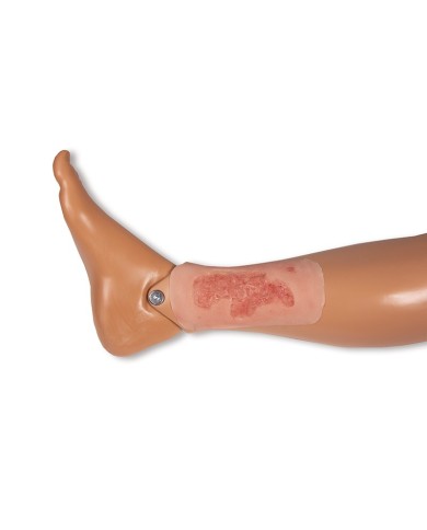 Moulage di ferita da ulcera arteriosa degli arti inferiori piccola in fas