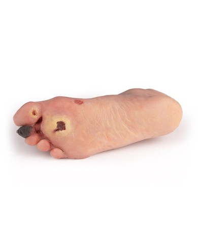 Piede diabetico con ferite Erler Zimmer PW006