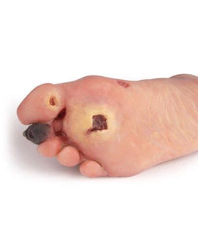 Piede diabetico con ferite Erler Zimmer PW006